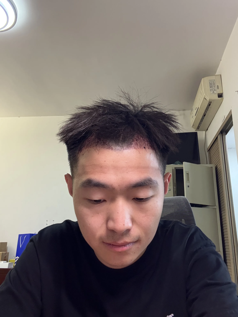 2025-03-02：植发手术术后第一天-娃弟的人生纪实论坛-生活分类-娃与娃
